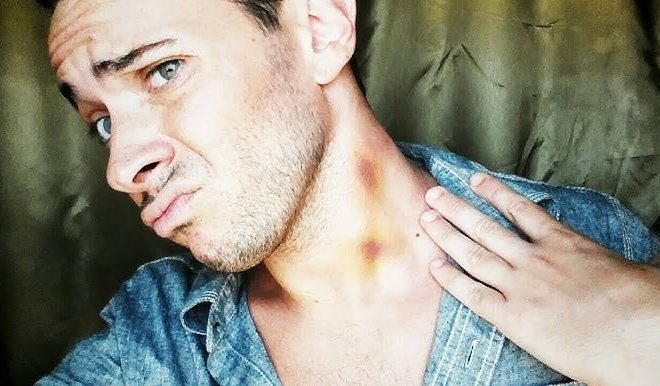 How to Whisk Out a Hickey